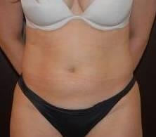 Liposuction Before & After Image