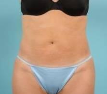 Liposuction Before & After Image