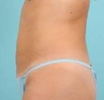 Liposuction Before & After Image