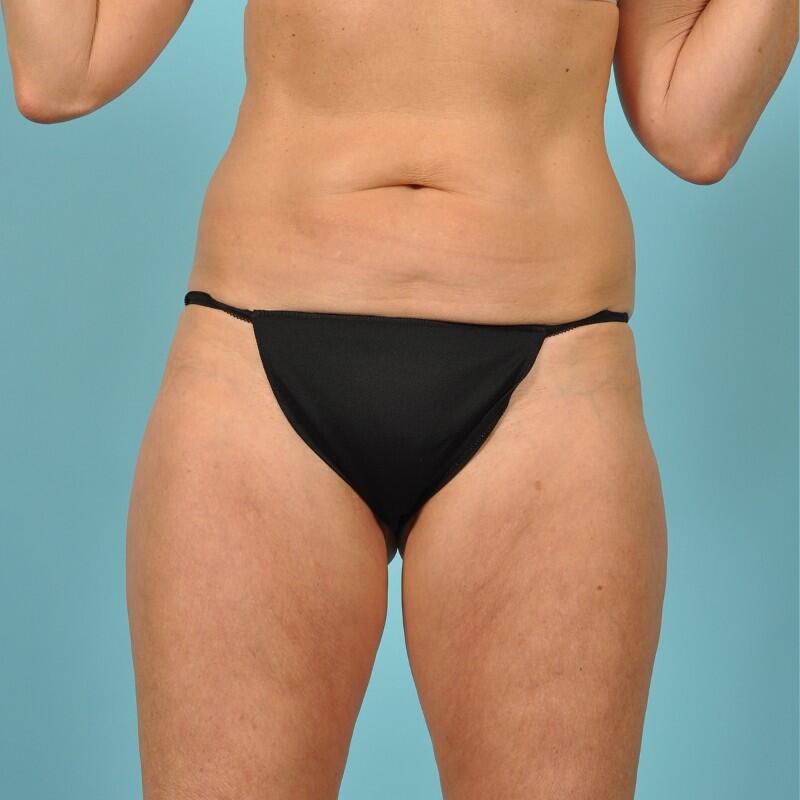 Liposuction Before & After Image Patient 27429
