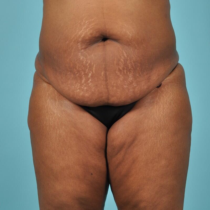 Liposuction Before & After Image