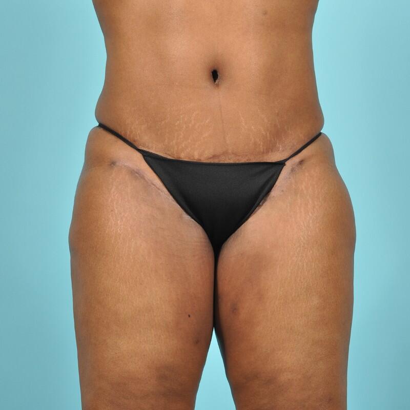 Liposuction Before & After Image