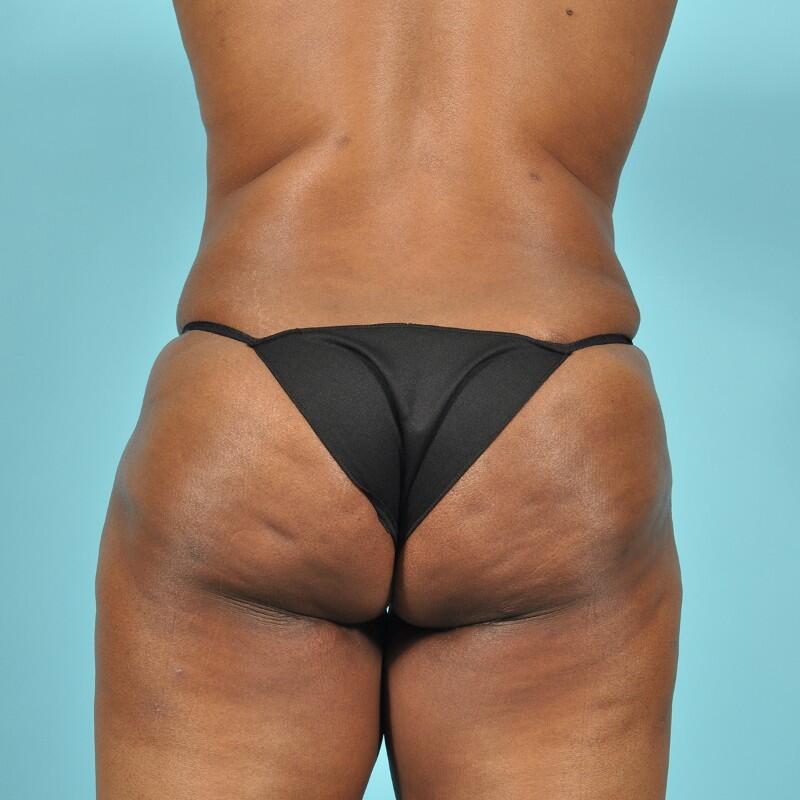 Liposuction Before & After Image