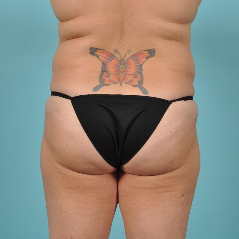 Liposuction Before & After Image Patient 27431