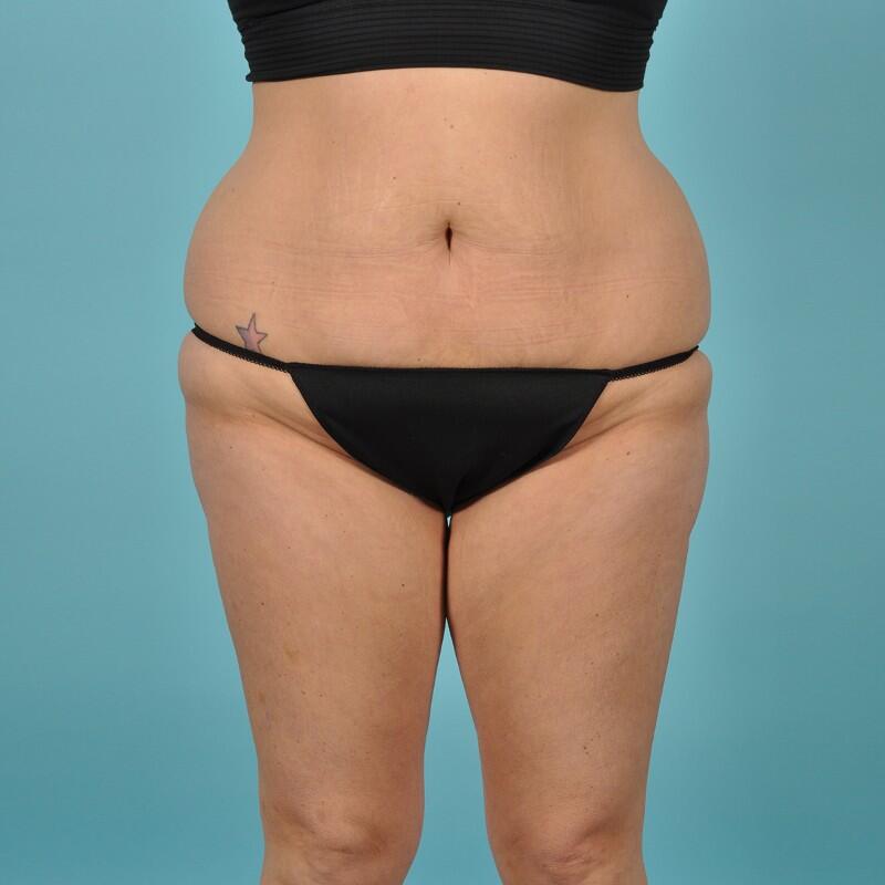 Liposuction Before & After Image Patient 27432