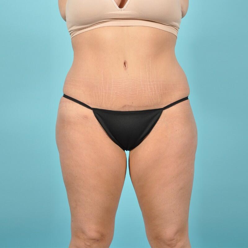 Liposuction Before & After Image Patient 27432