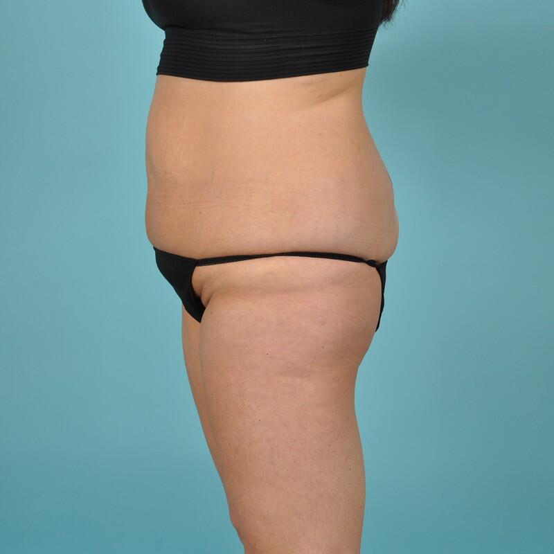 Liposuction Before & After Image Patient 27432