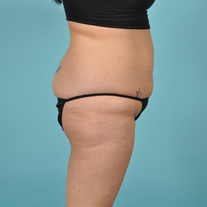 Liposuction Before & After Image