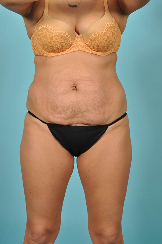 Liposuction Before & After Image