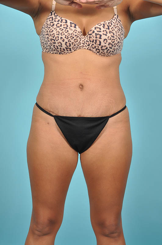 Liposuction Before & After Image