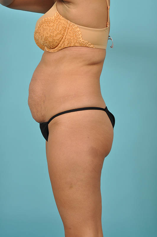 Liposuction Before & After Image