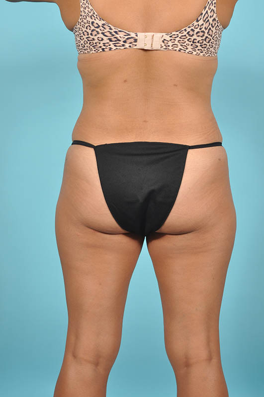 Liposuction Before & After Image Patient 27433