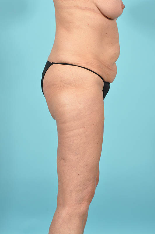 Liposuction Before & After Image Patient 28938