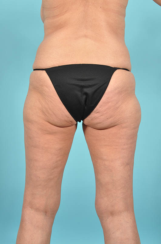 Liposuction Before & After Image