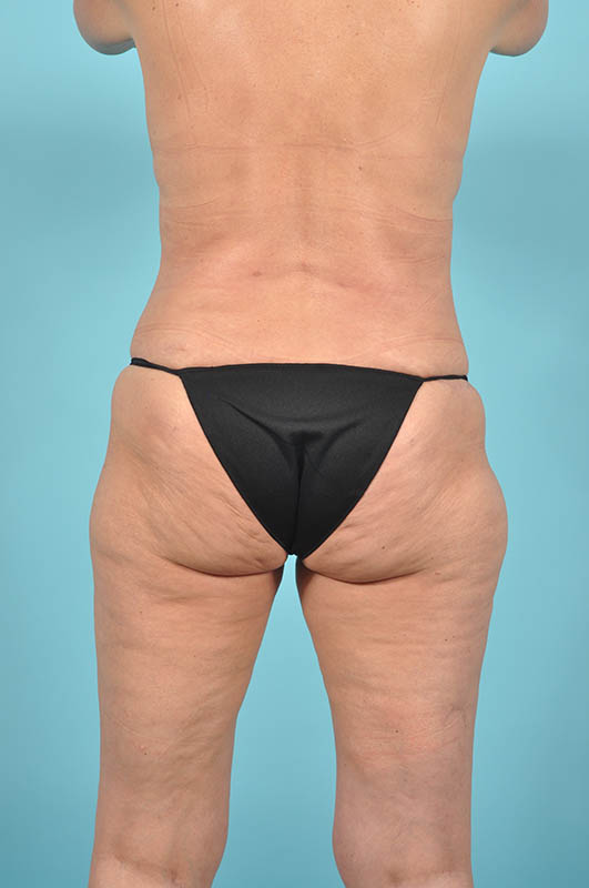 Liposuction Before & After Image