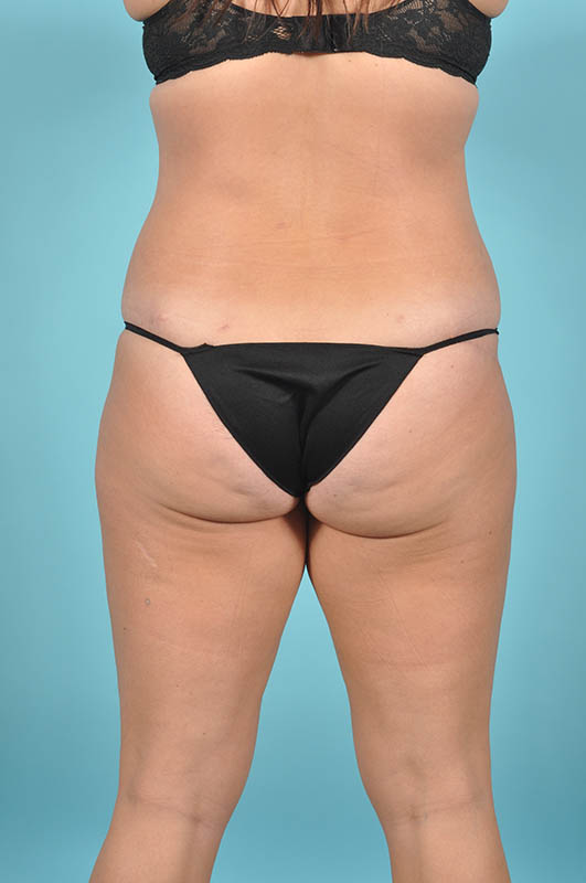 Liposuction Before & After Image