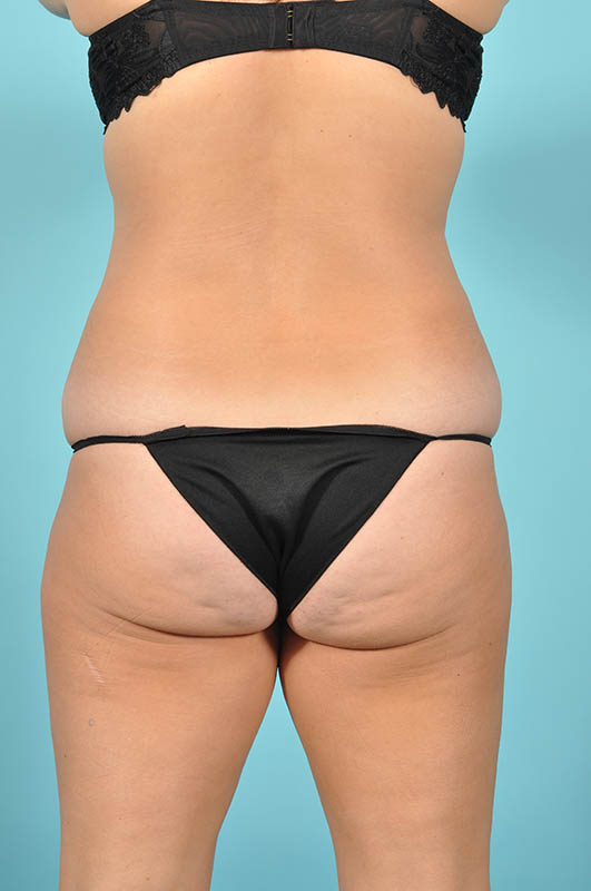 Liposuction Before & After Image Patient 29765
