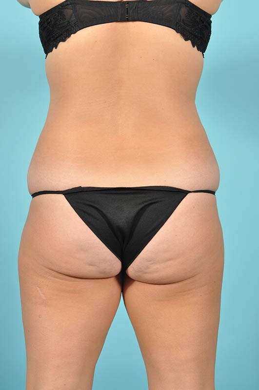 Liposuction Before & After Image