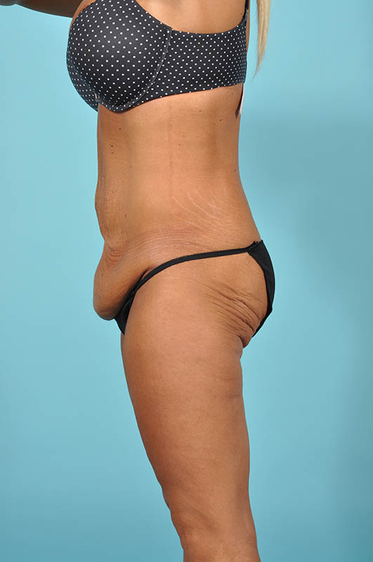 Liposuction Before & After Image