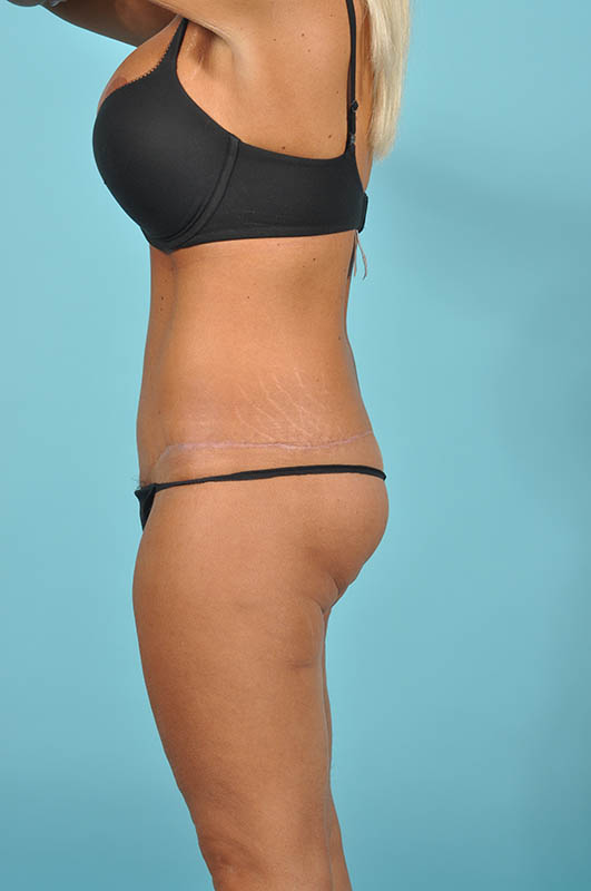 Liposuction Before & After Image