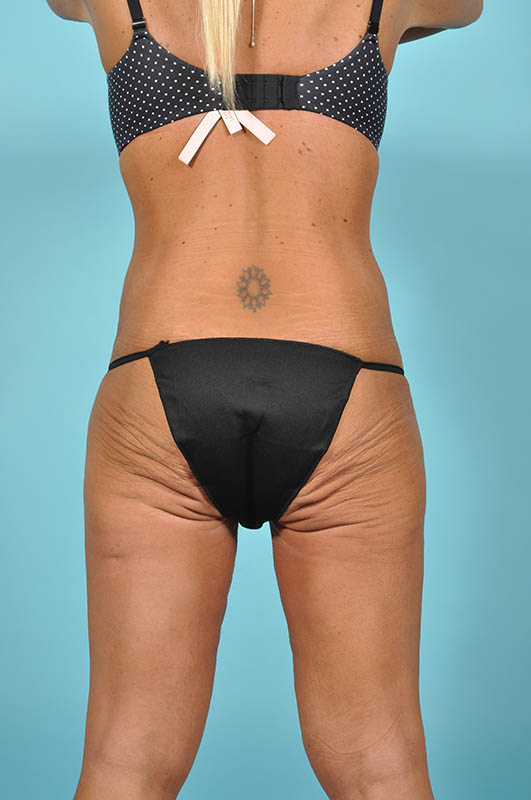 Liposuction Before & After Image