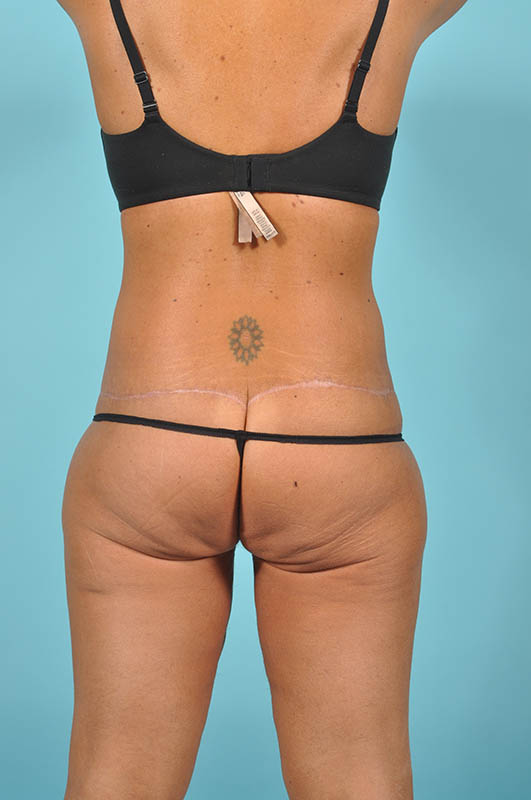 Liposuction Before & After Image