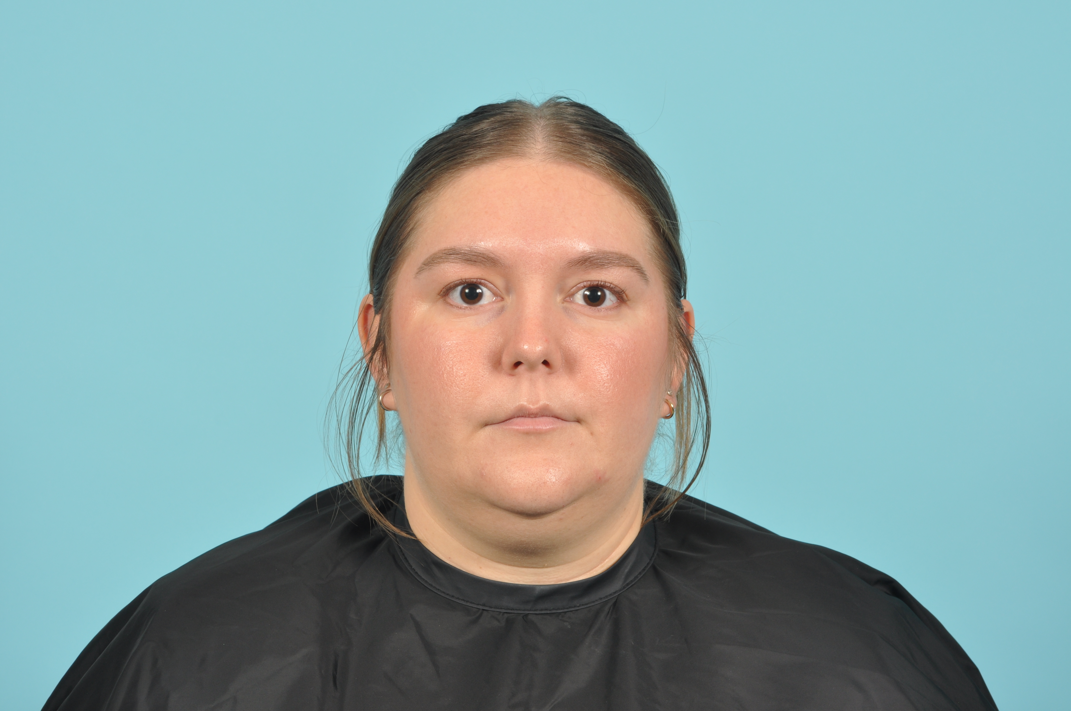 Liposuction Before & After Image