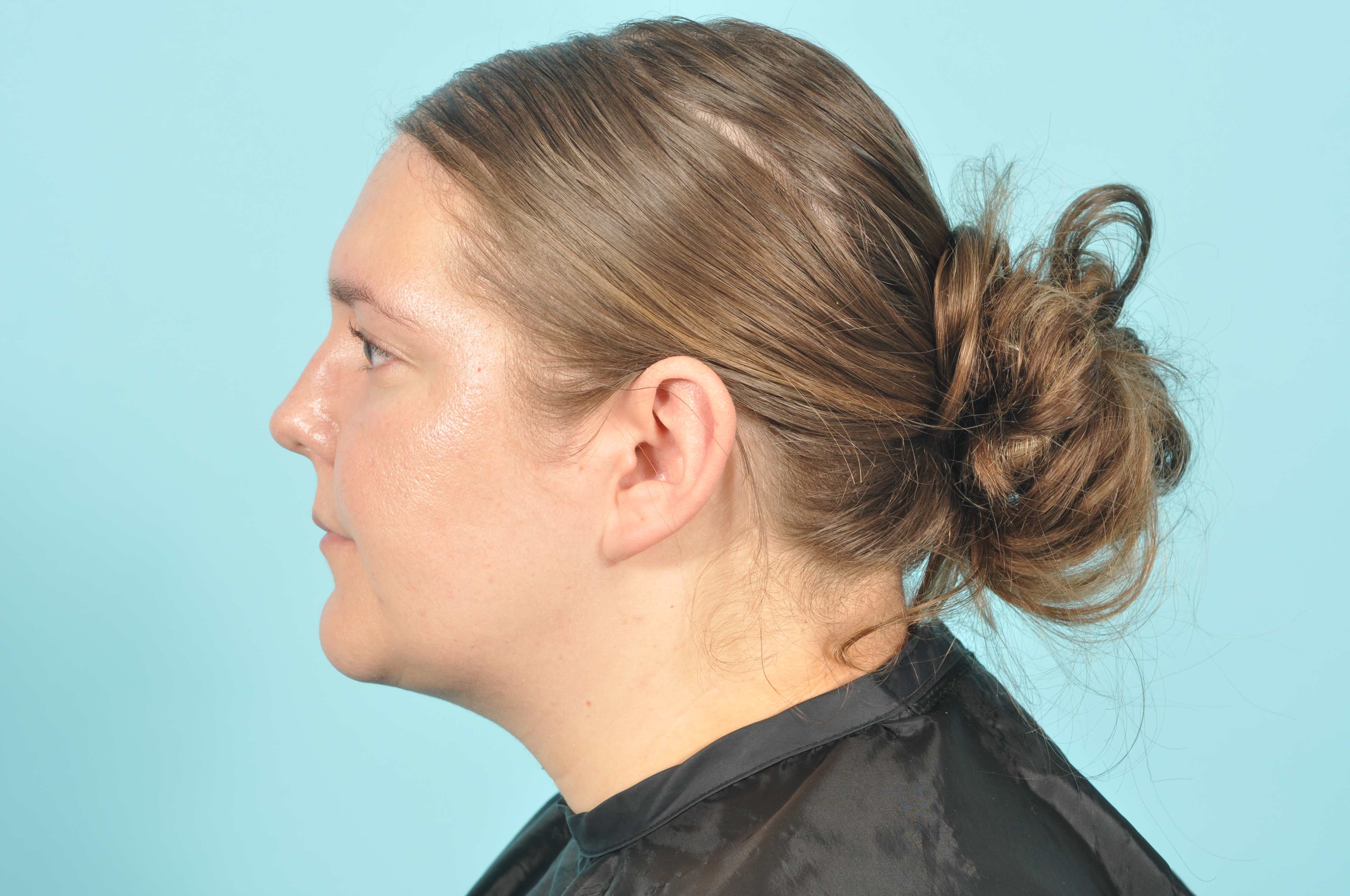 Liposuction Before & After Image