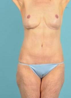 Mommy Makeover Before & After Image Patient 24500