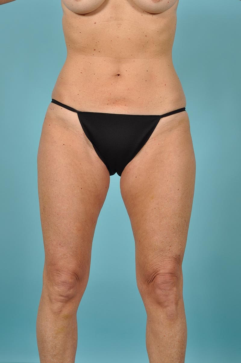 Thigh Lift Before & After Image Patient 11425