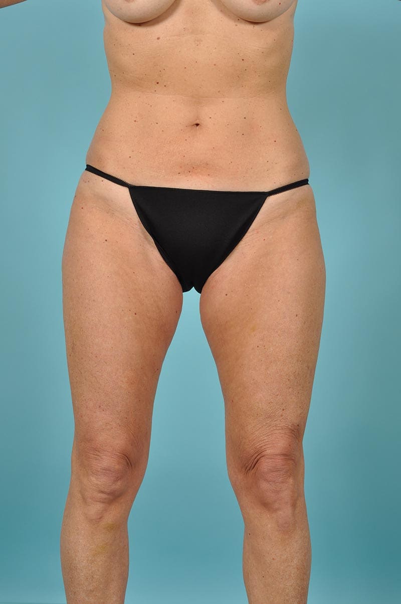 Thigh Lift Before & After Image