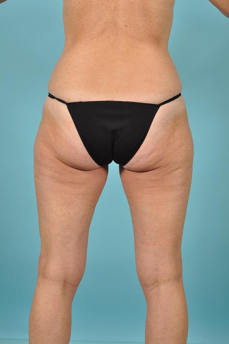 Thigh Lift Before & After Image Patient 11425