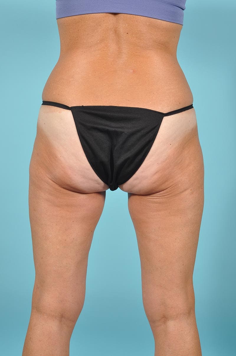 Thigh Lift Before & After Image Patient 11425