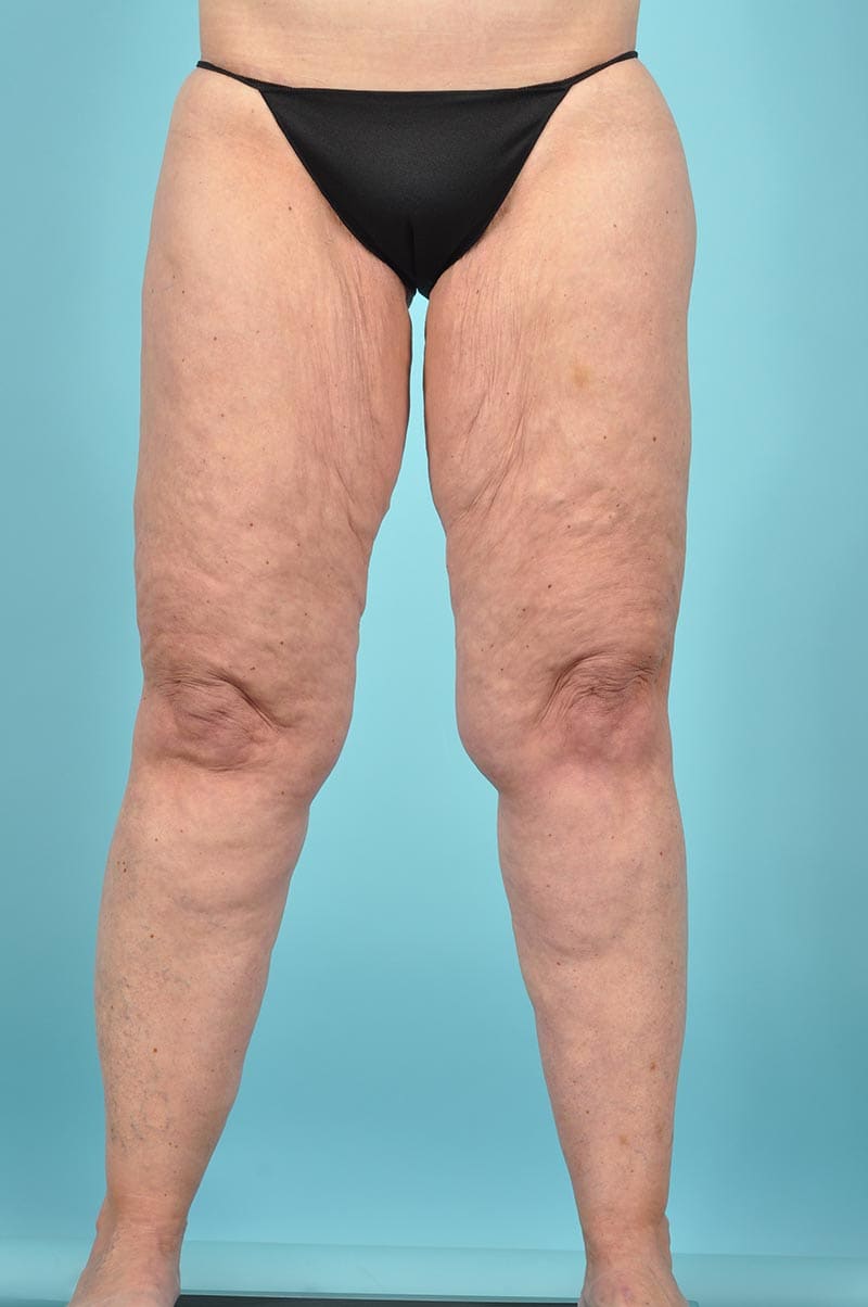 Thigh Lift Before & After Image