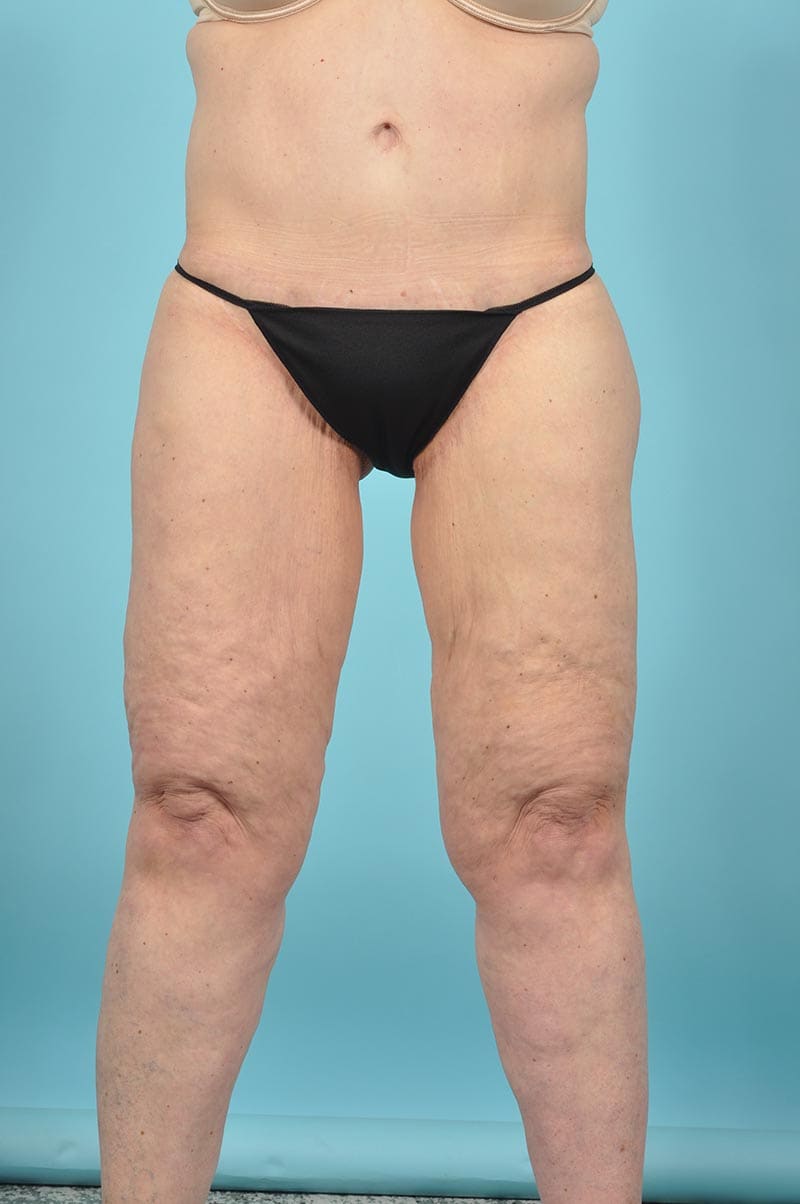 Thigh Lift Before & After Image