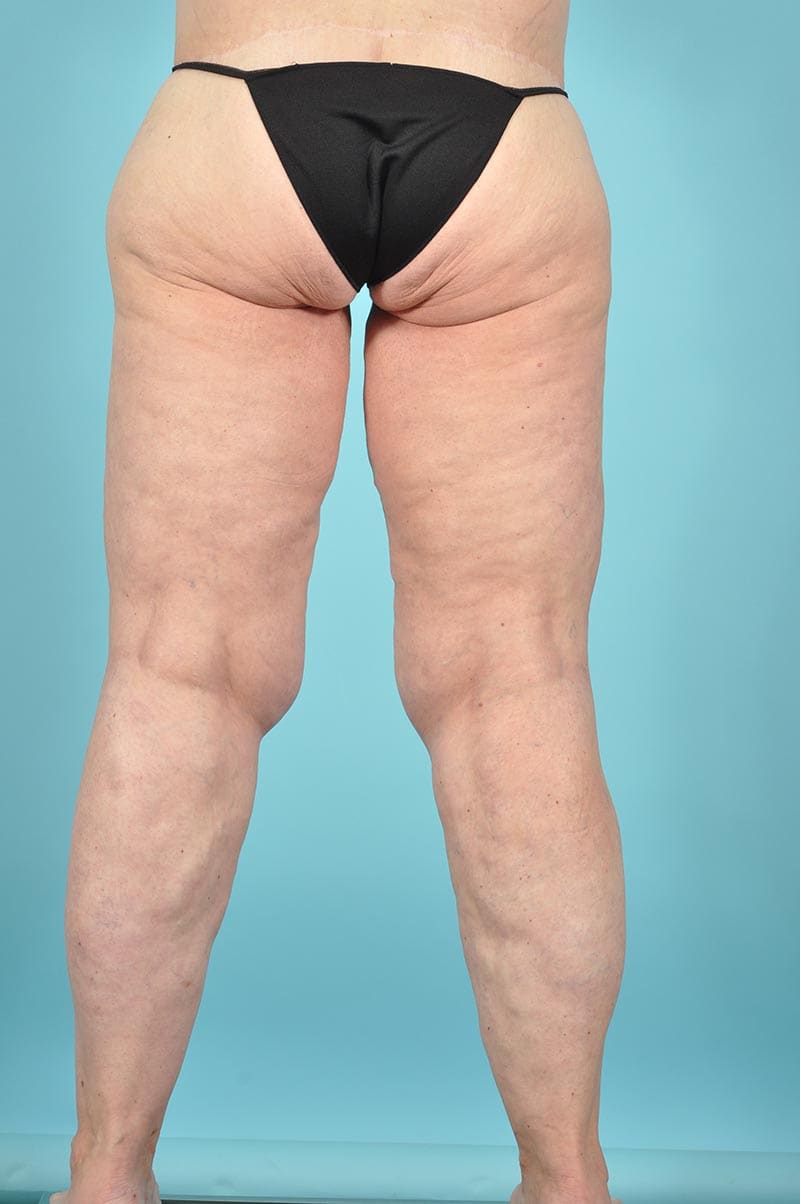 Thigh Lift Before & After Image