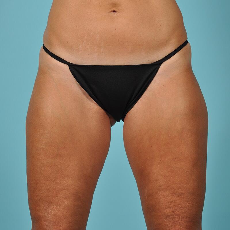 Thigh Lift Before & After Image Patient 25001