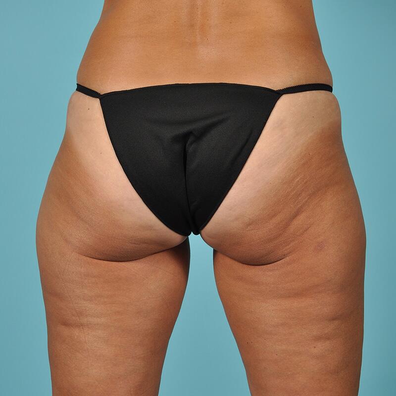 Thigh Lift Before & After Image