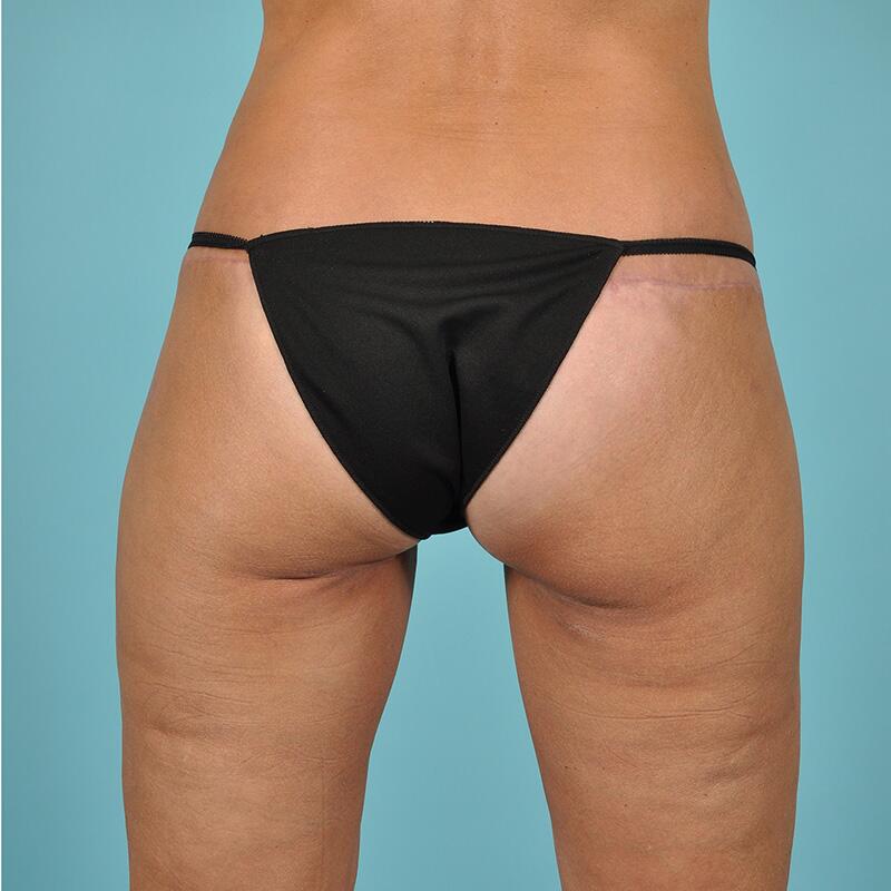 Thigh Lift Before & After Image Patient 25001