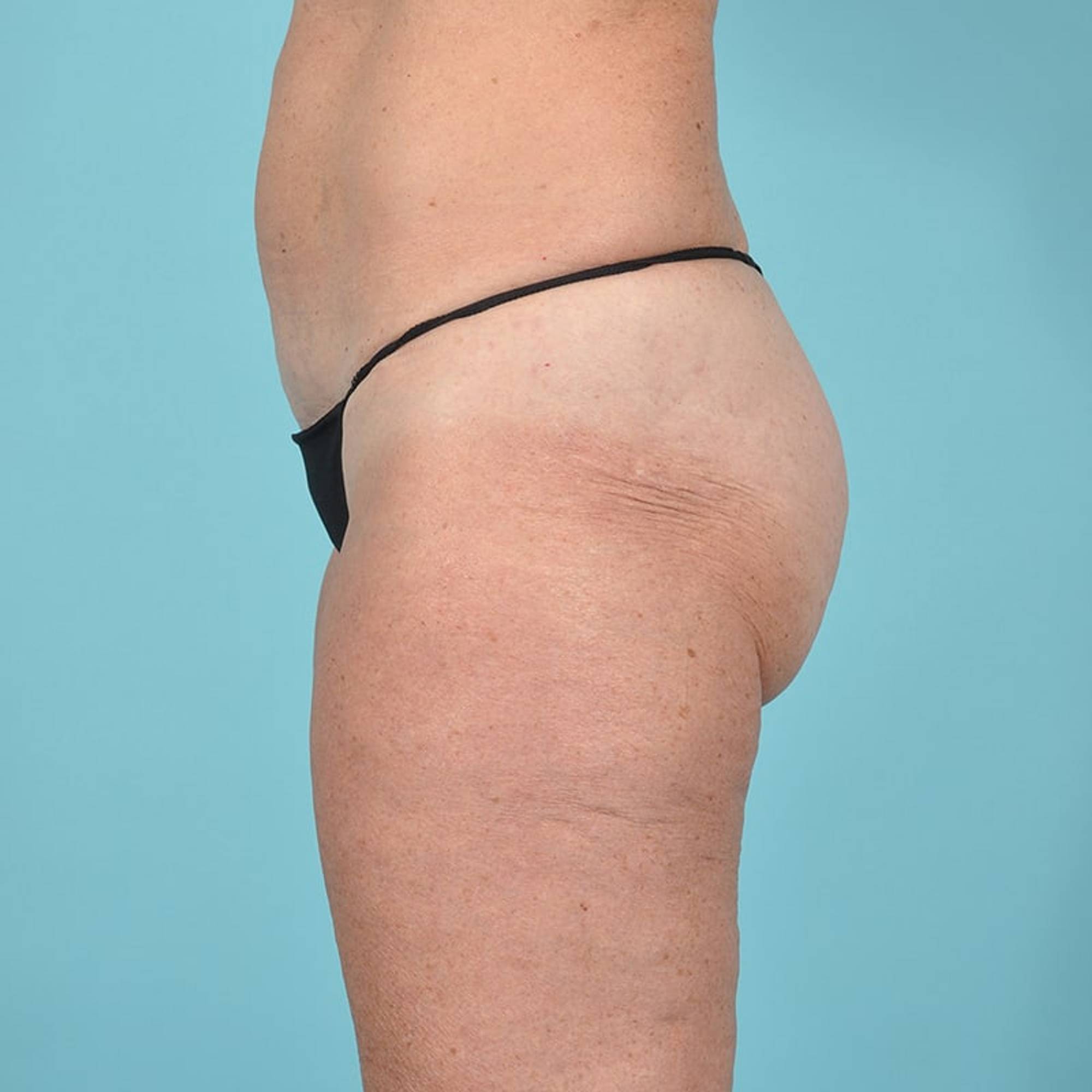 Thigh Lift Before & After Image