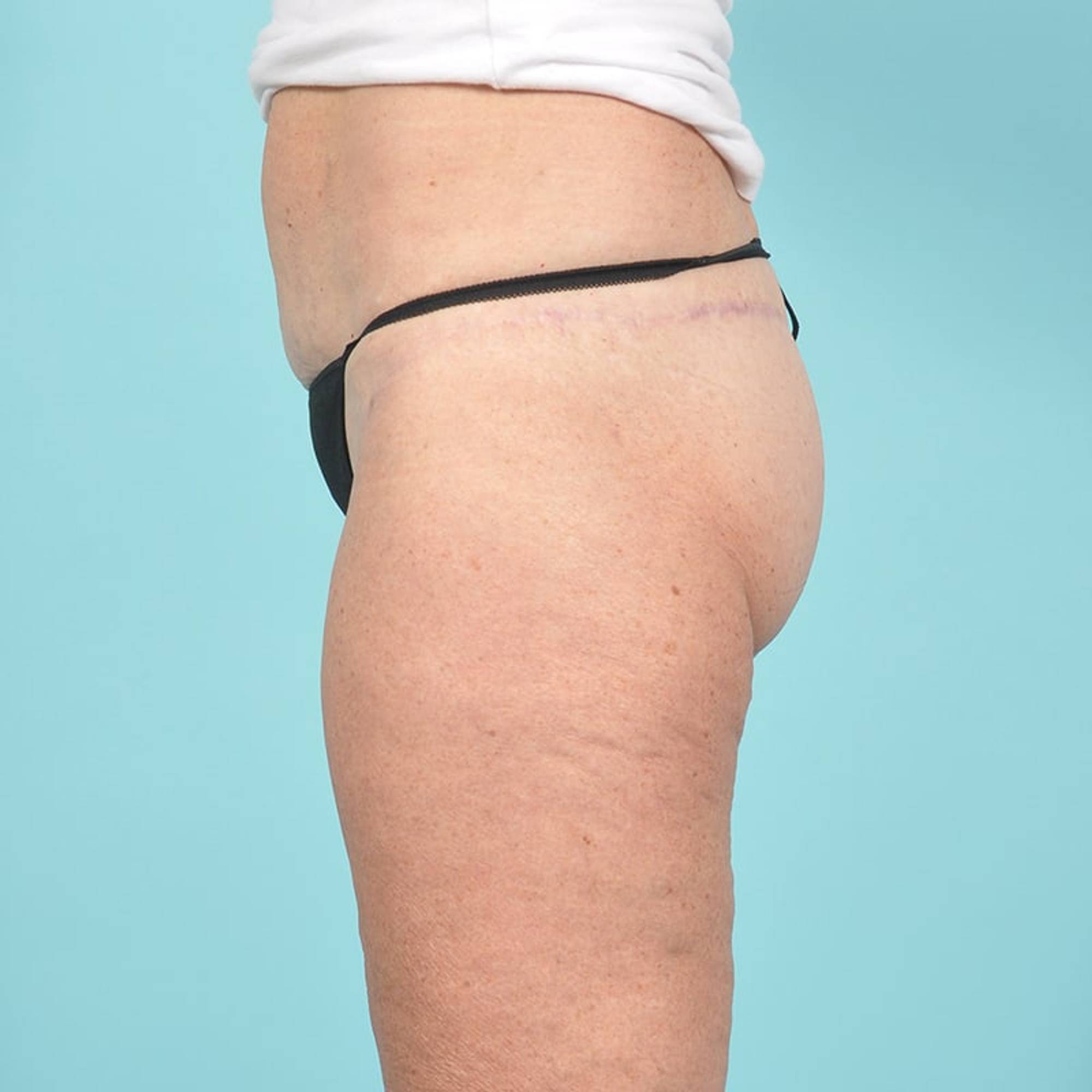 Thigh Lift Before & After Image
