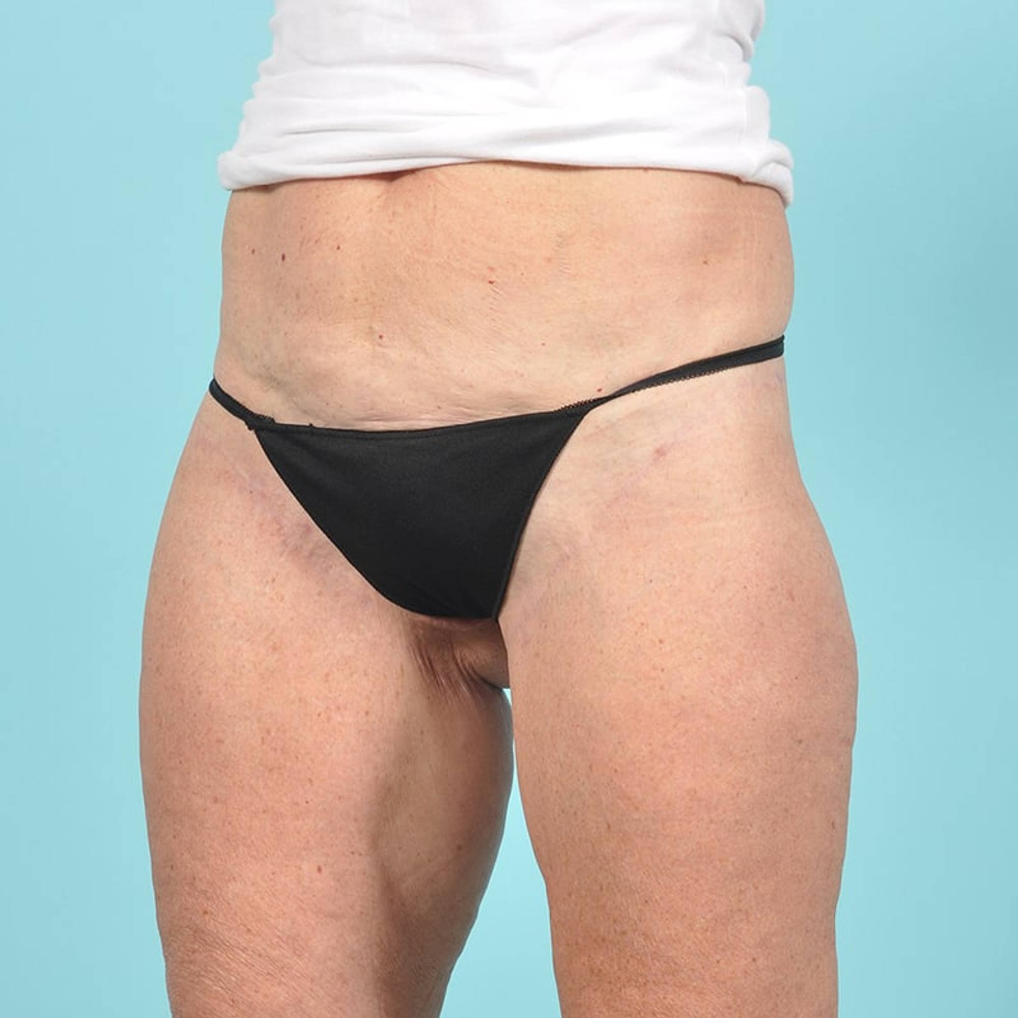 Thigh Lift Before & After Image