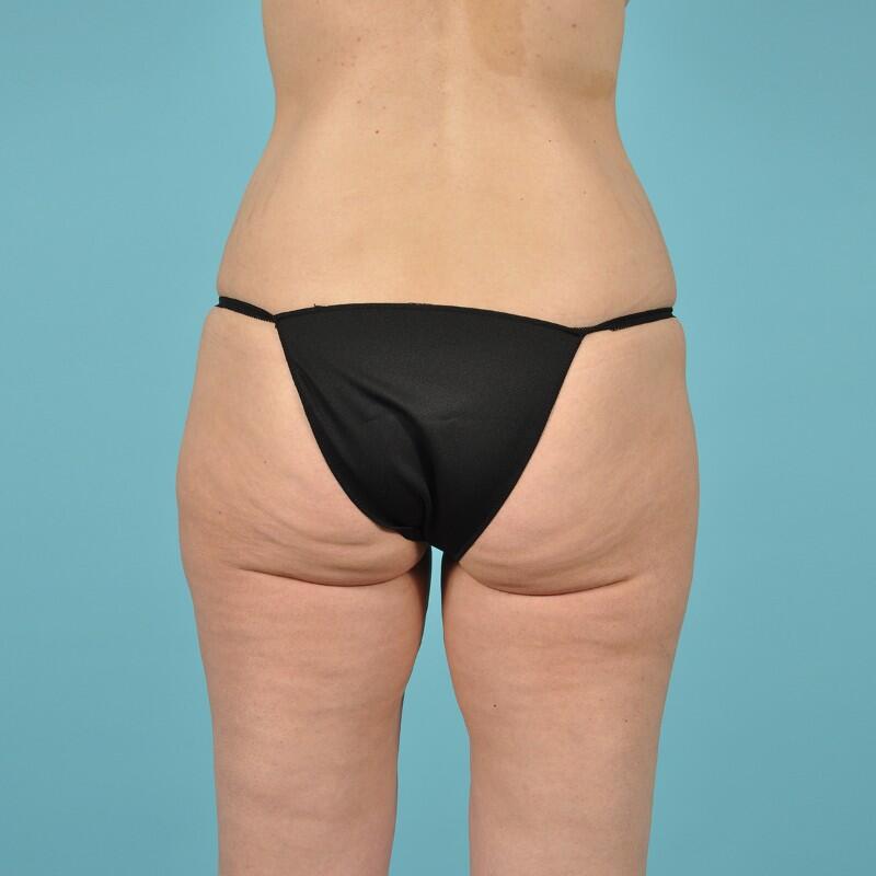 Tummy Tuck Before & After Image