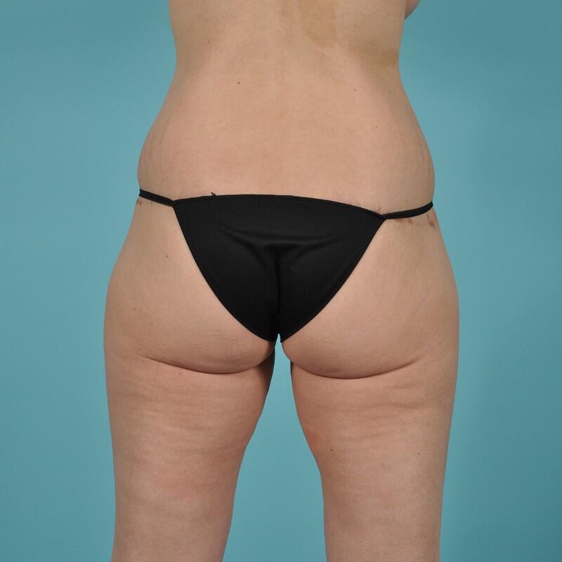 Tummy Tuck Before & After Image