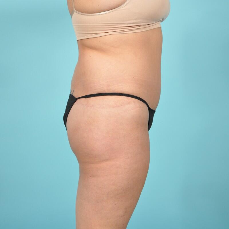Tummy Tuck Before & After Image Patient 26625