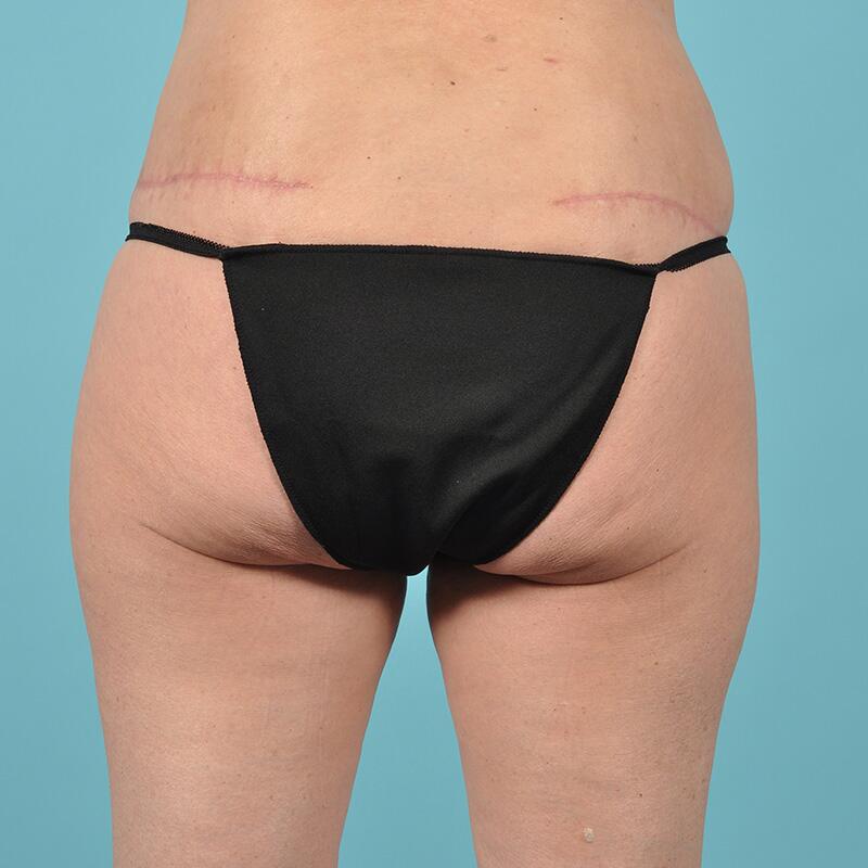 Tummy Tuck Before & After Image