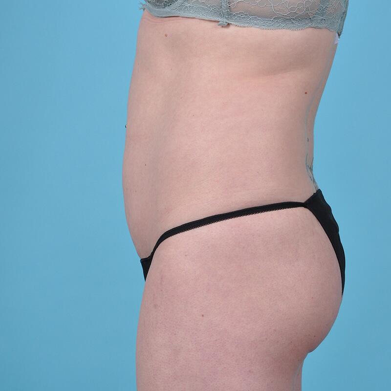 Tummy Tuck Before & After Image Patient 26630