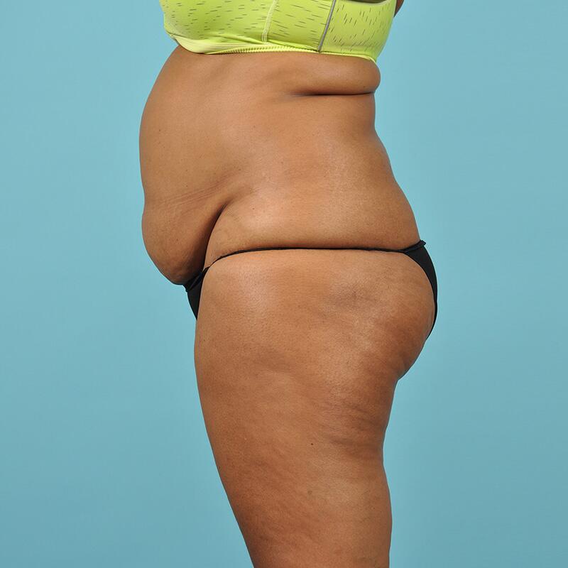 Tummy Tuck Before & After Image Patient 26633