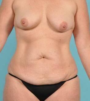 Tummy Tuck Before & After Image Patient 26635