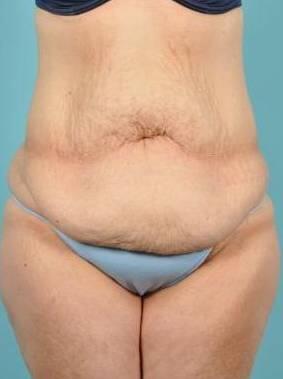 Tummy Tuck Before & After Image Patient 26636